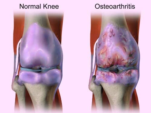 image_6811e-Knee-Osteoarthritis inflammatory and mechanical pain